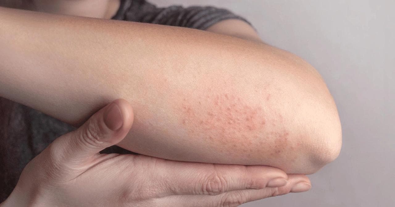 Three Mechanisms Behind Zepbound-Related Itching