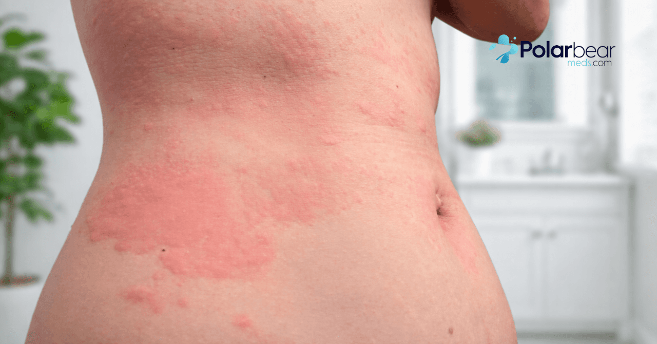 Why Does Zepbound Cause Skin Sensitivity