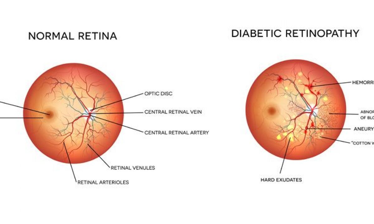 can diabetic retinopathy be reversed