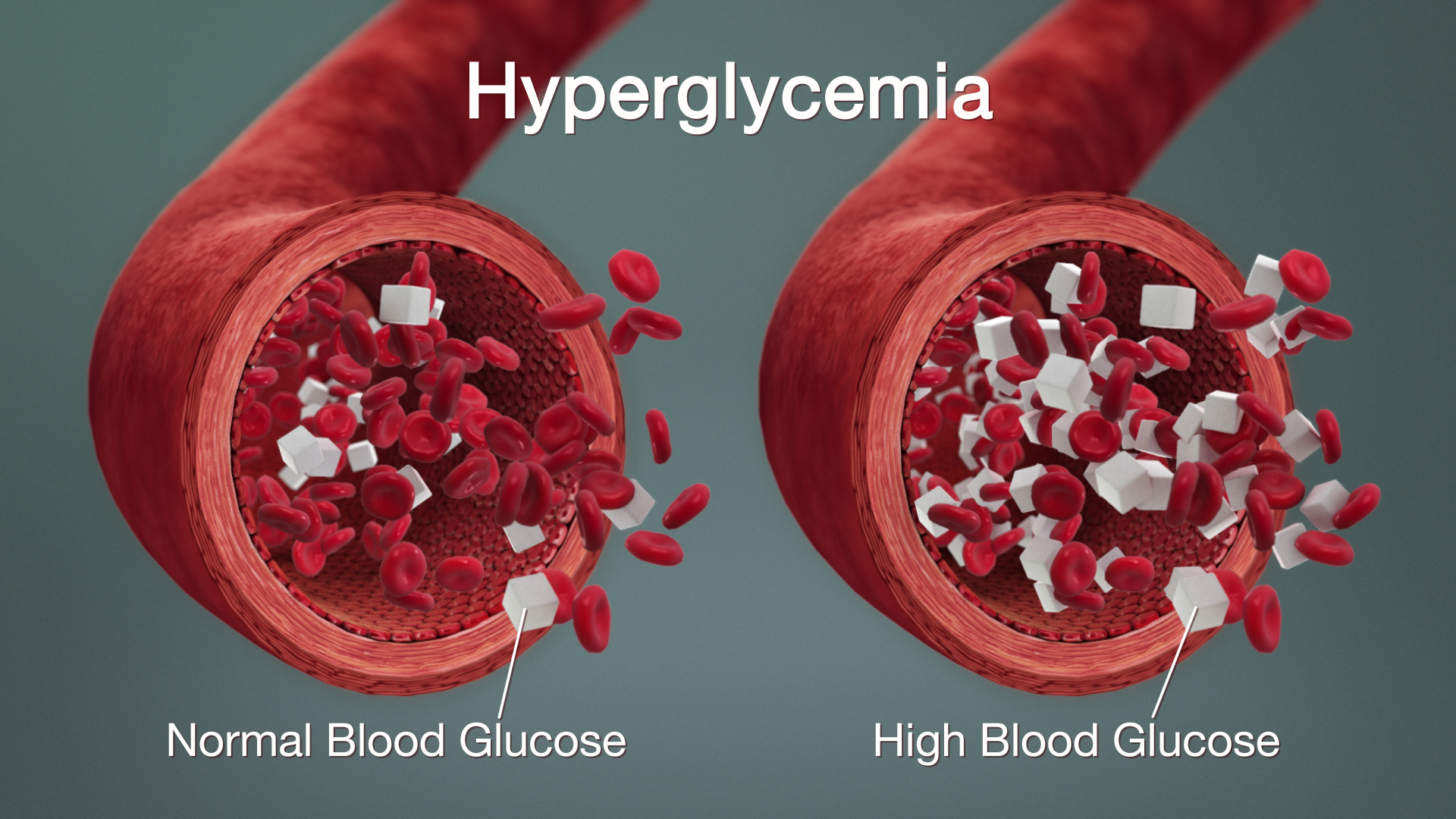 Symptoms of Hyperglycemia Causes, Diagnosis and Treatment