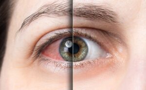 Cequa Vs Restasis: Key Differences in Dry Eye Treatment Options