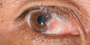 Wegovy Eye Side Effects: Can Semaglutide Affect Vision?