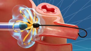 Wegovy and AFib: How Weight Loss Influences Heart Disease Risk