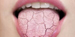 Wegovy Dry Mouth: How to Manage Dry Mouth from Semaglutide