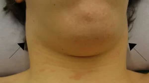 Can Mounjaro Cause Swollen Lymph Nodes?